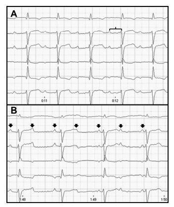 Notice sinus bradycardia with a rate of 120 beats/min, conducted with a pronounced first- degree atrioventricular block